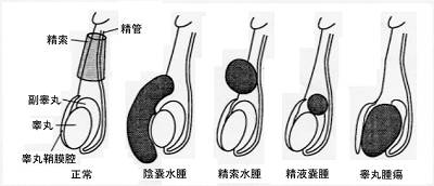 精液瘤(精液嚢腫) Spermatocele