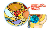 前立腺がん 好発部